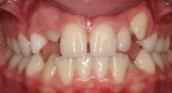 Smile before orthodontic treatment